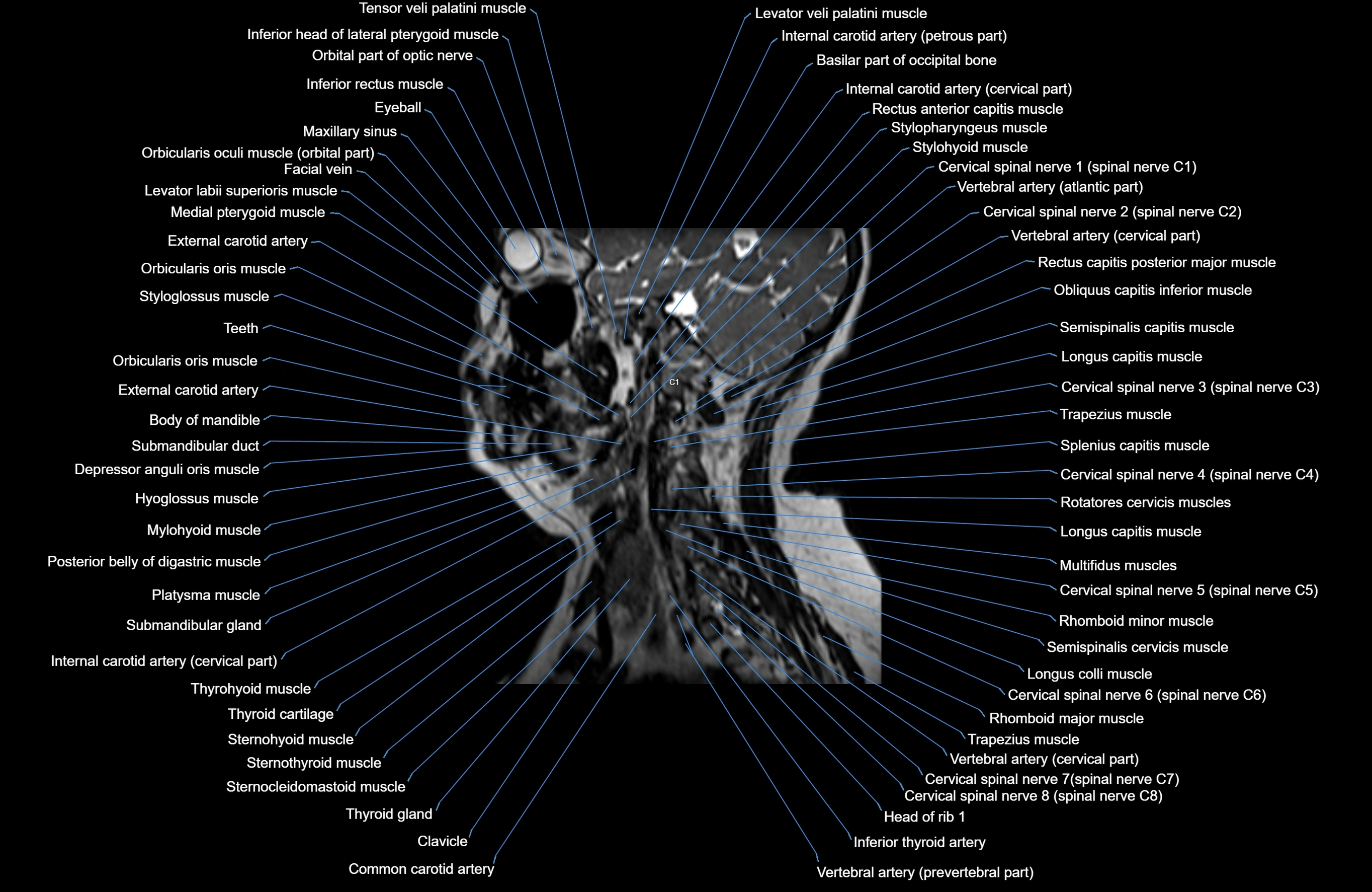 Neck MRI sagittal cross sectional anatomy 3D 1mm 3T radiology  image-img-00001-00016.webp